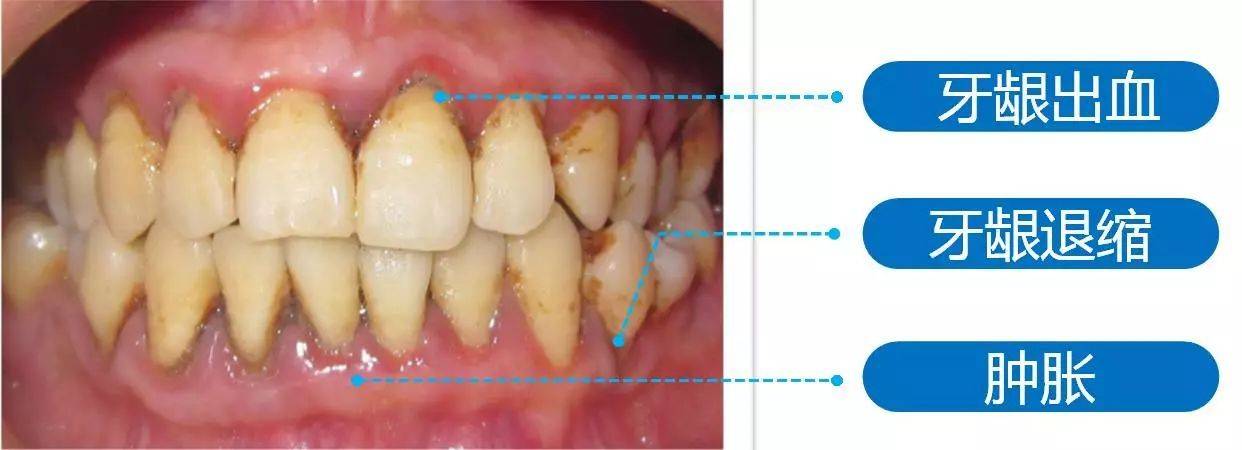 牙龈和龈颊沟示意图图片
