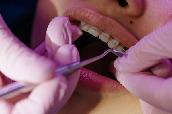 牙齿正畸后复发的原因是什么？应该怎么处理呢？