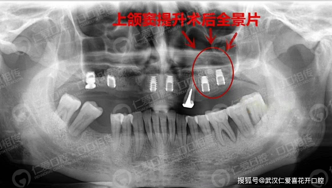 牙槽骨萎縮 ▎上頜竇內提升 植骨修復