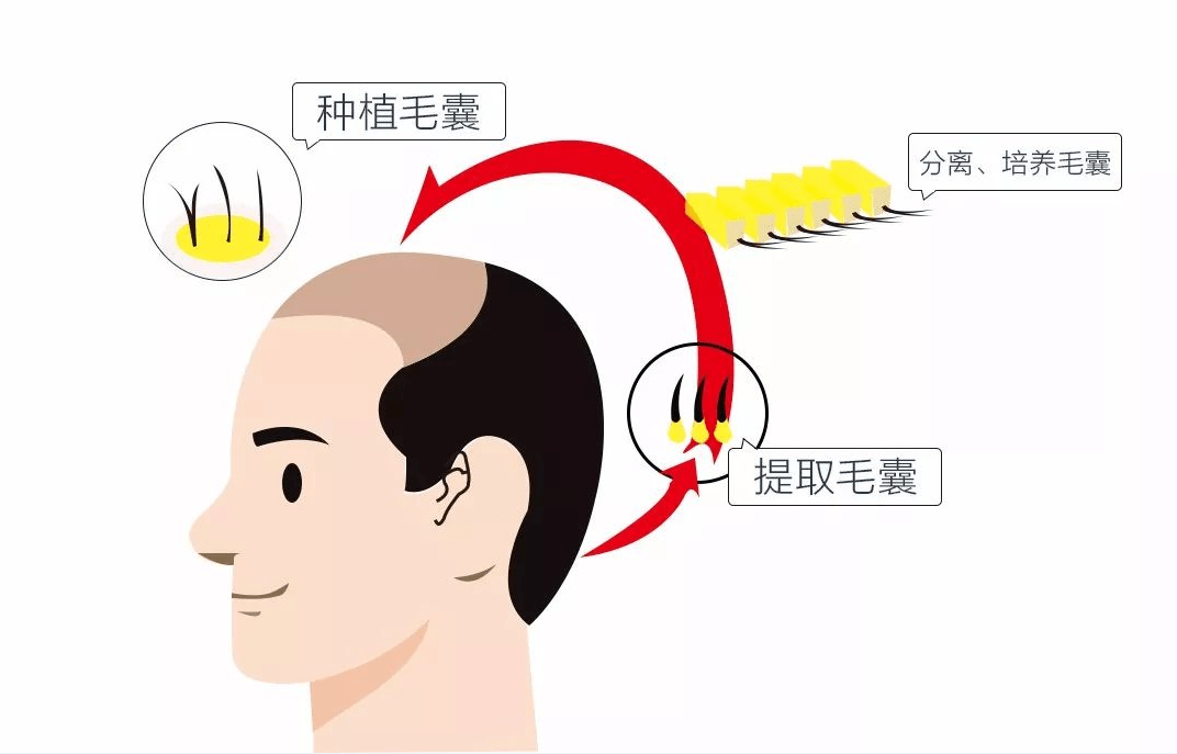 毛囊普拉朵植发丨植发真的有效吗？