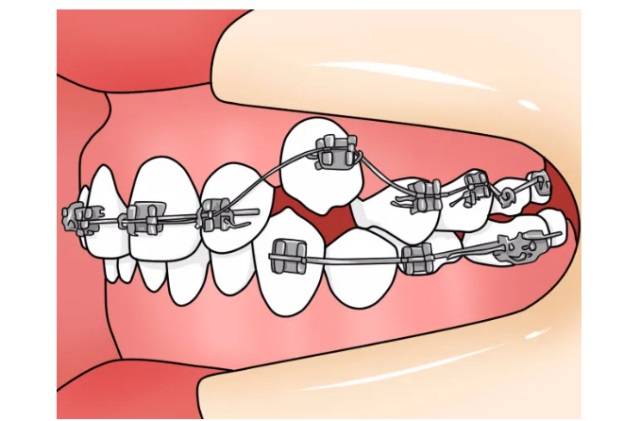 普通金属托槽正畸第一步,从了解牙套开始!