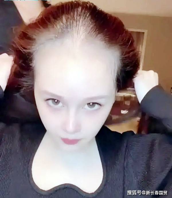 赵本山女儿无美颜近照吓坏网友,面色苍白脱发严重酷似"裘千尺"