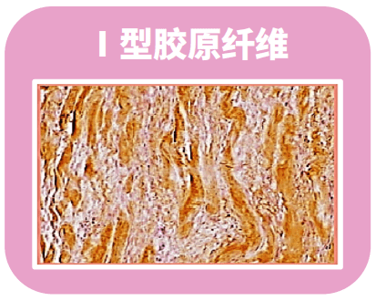 i型胶原蛋白粗大,决定着皮肤轮廓和硬度;iii型胶原蛋白是细密纤维状