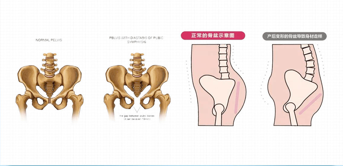 正常情況下,骨盆呈收緊狀態,內臟器官也各司其職,肌肉韌帶相對應也