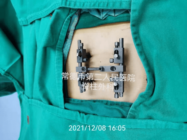 常德|常德市第二人民医院脊柱外科微创技术再次新突破——微创弹性外固定的应用