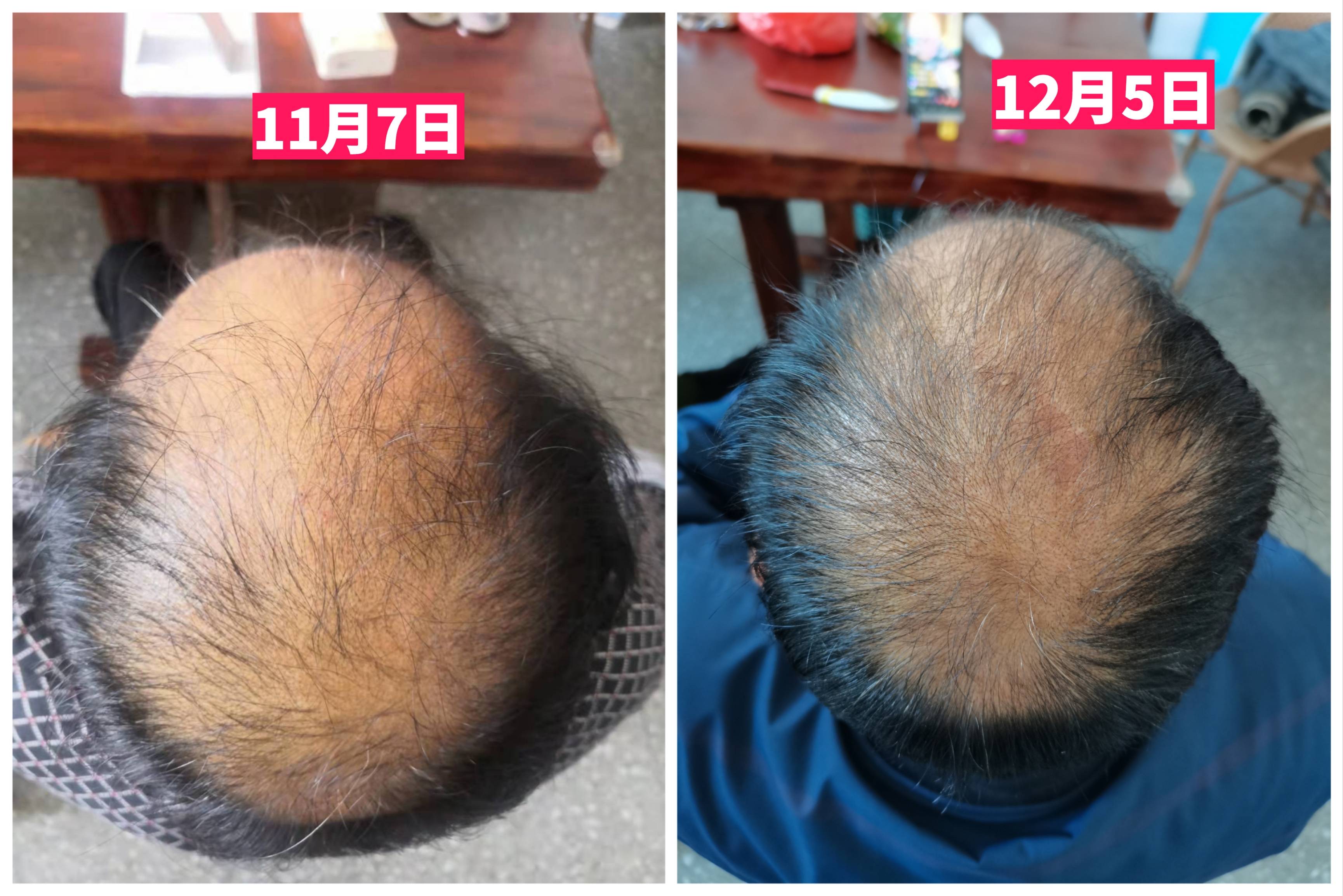 禤氏古方头疗案例二,又是一个不看后悔系列_效果_头发_胡先生