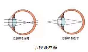 激光|近视手术全解答（番外篇）近视激光矫正术后为什么还要戴老花镜？