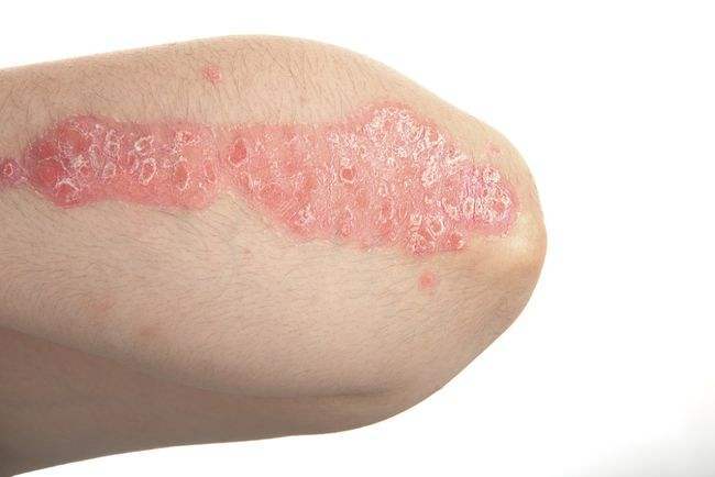 神经性皮炎也被称为慢性单纯性苔藓,这是很常见的皮肤性疾病,患上该