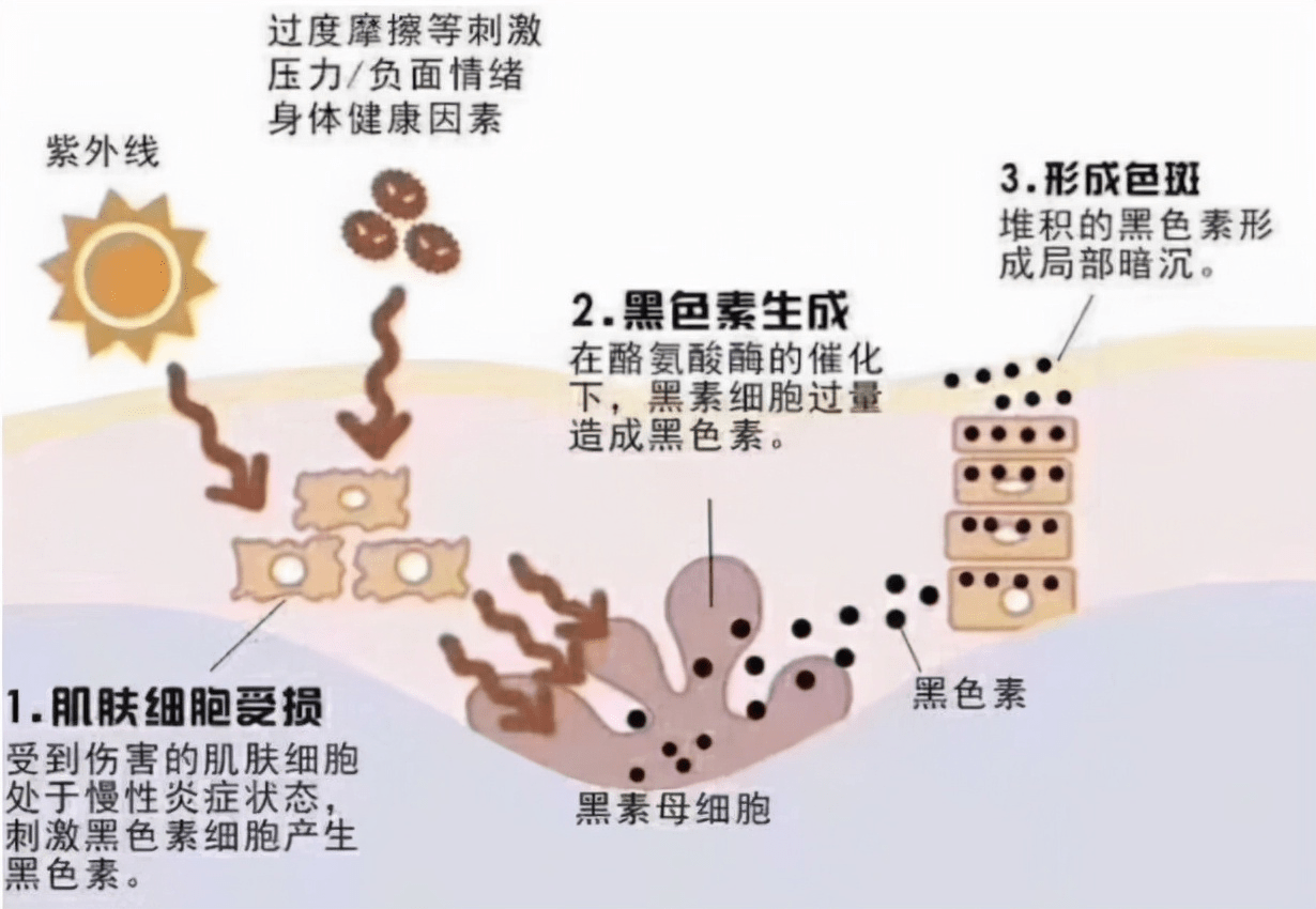 雀斑“斑”门弄斧，天玑雪教科学祛斑~