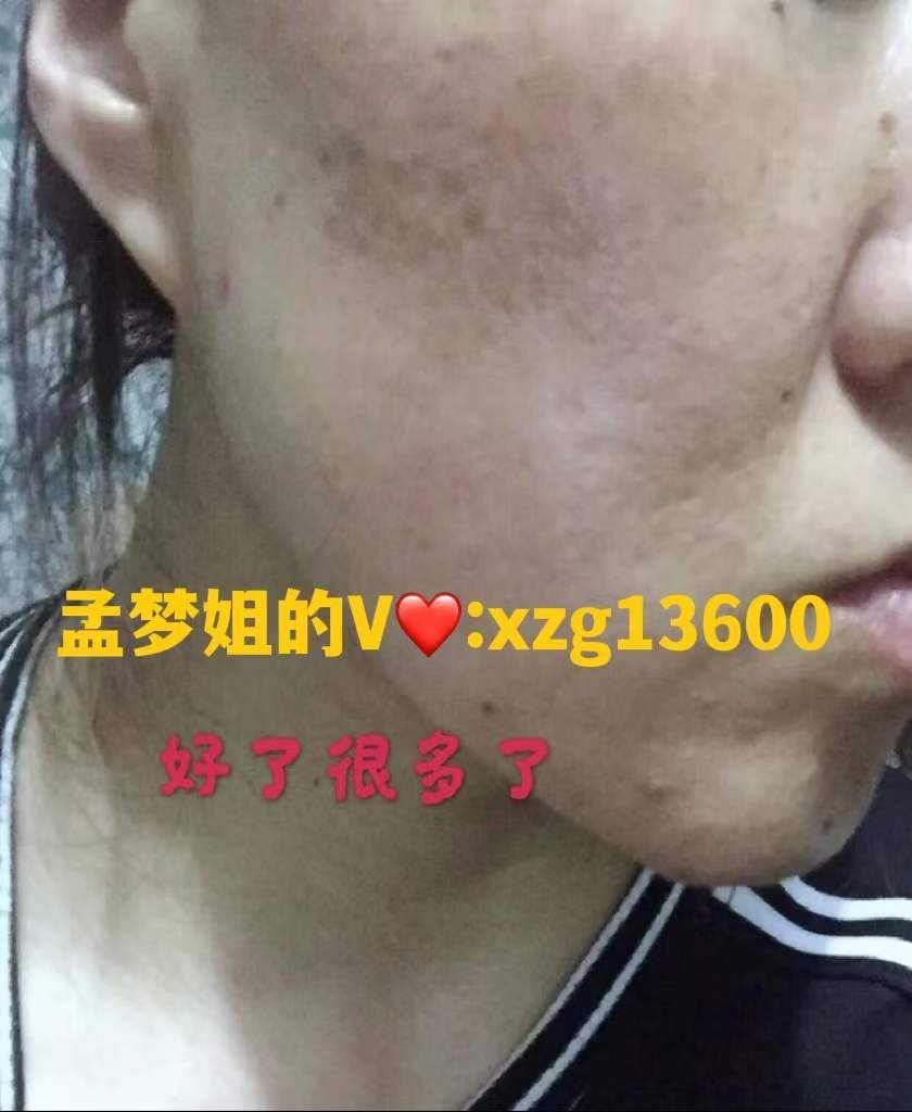 因为谭舒柳的祛痘是真的吗？谭舒柳有没有效果？