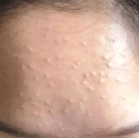 偏方迷惑丨为什么额头上的闭口总是反反复复的？