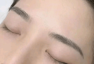 治疗索兰黛的结痂期得多注意啥？细细听我说！