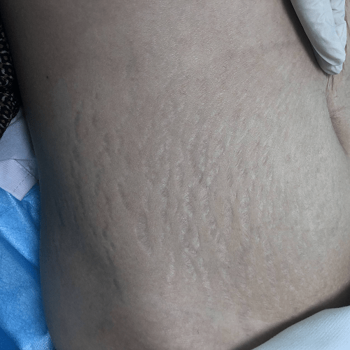 想要预防妊娠纹,这4件事情一个都不能漏_保养_肚子_宝宝