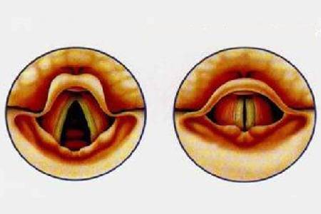 声带裂了图片