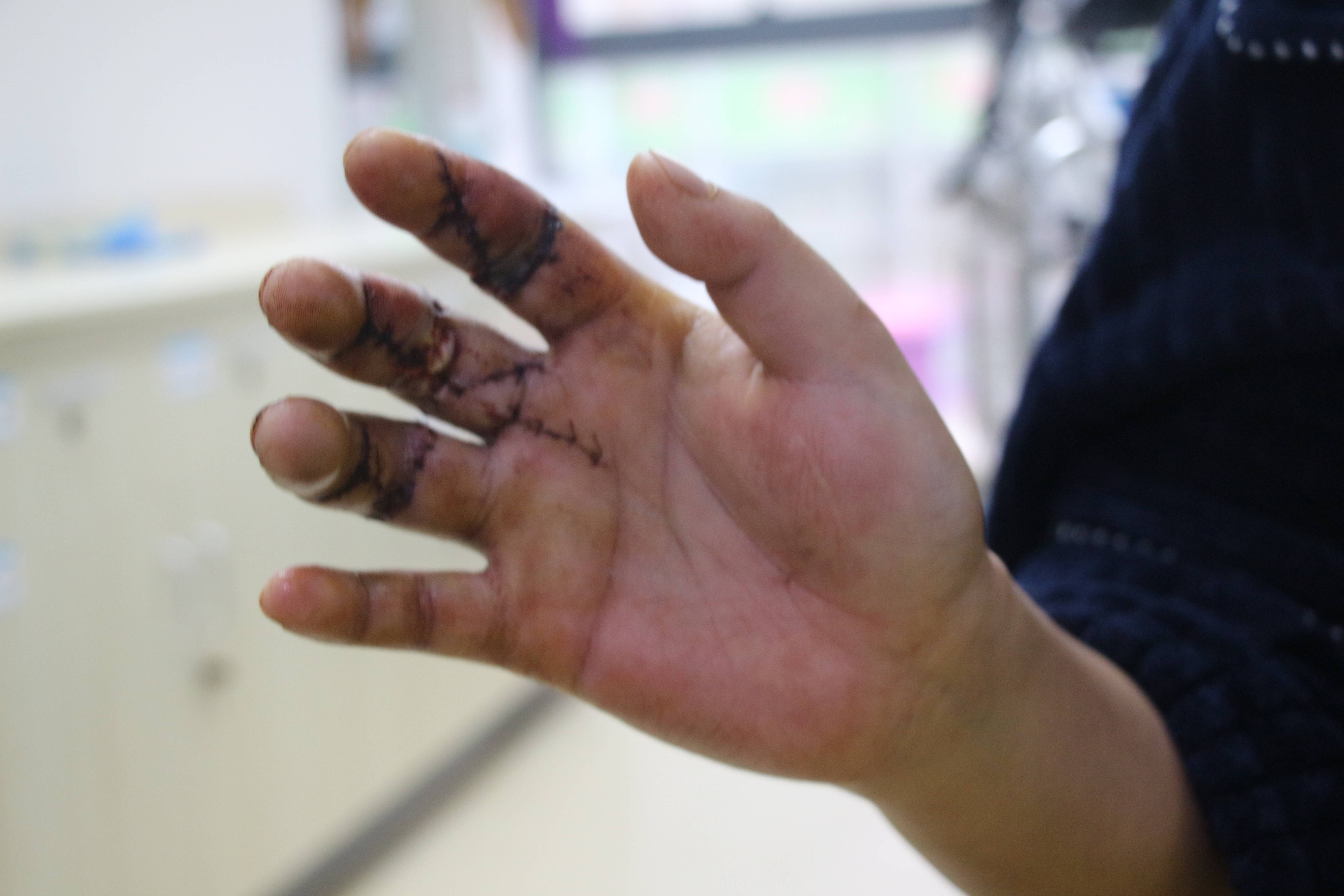 是长航东院骨科的专家治疗好了他的手掌这位来自宜都的手外伤患者,左