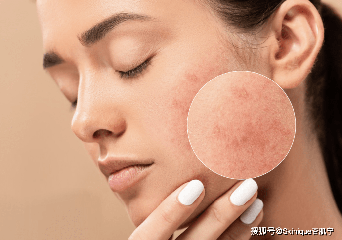滑嫩还在为脸上的痘痘而烦恼吗？get正确祛痘方法