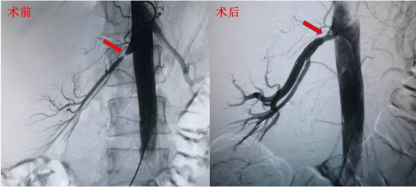 病因|25岁女性突发高血压 专家提醒：年轻人高血压警惕背后致病因