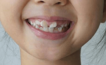 把保护措施做的滴水不漏,可宝宝还是长出了他的第一,二,三,四颗龉齿