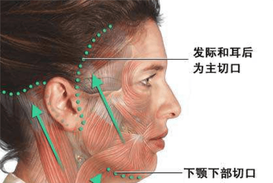 什么筋膜提升术是什么、筋膜提升拉皮手术维持多久