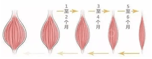 夏天李佳佳：夏天到了，瘦肩针值得打吗？