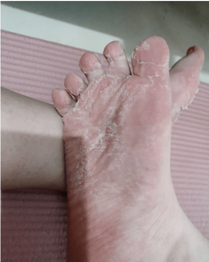 鳞屑型脚气:这种也叫做脚脱皮,这里不多说,看字面意