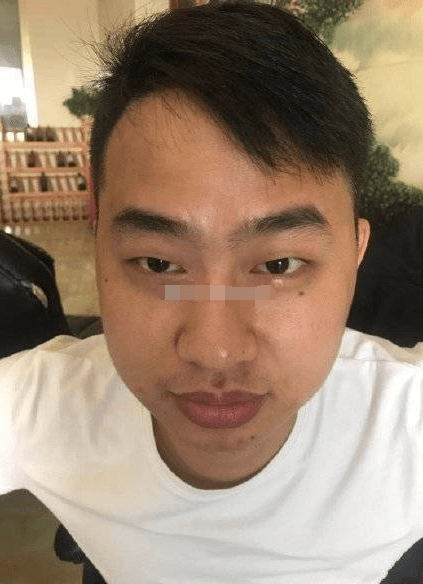 虽然重情义,但是脾气不稳容易急躁,结合印堂过窄,且有眉毛入侵印堂