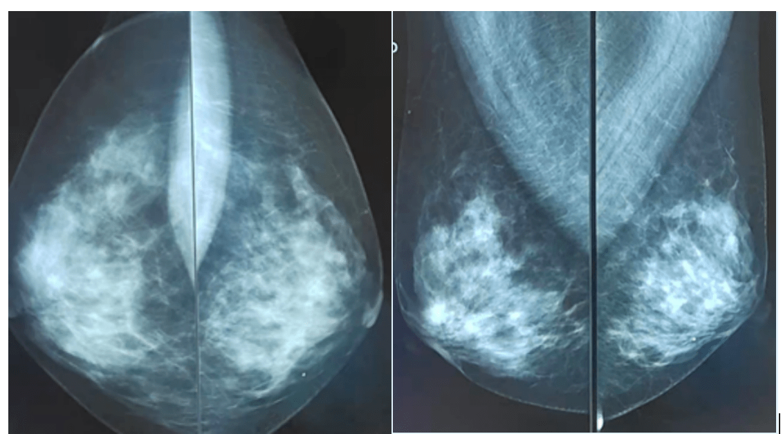乳腺癌检查单图片图片