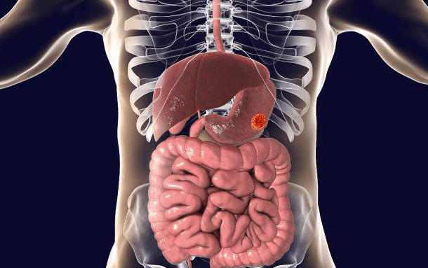 原創胃癌晚期身體會出現哪些徵兆聽聽醫生怎麼說