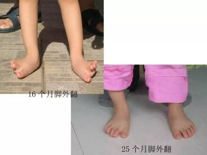 五个月宝宝剪刀脚图片图片