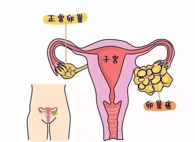 原创
            为什么卵巢癌一发现就是晚期？出现这些症状可能是卵巢在向你“求救”~
                
                 