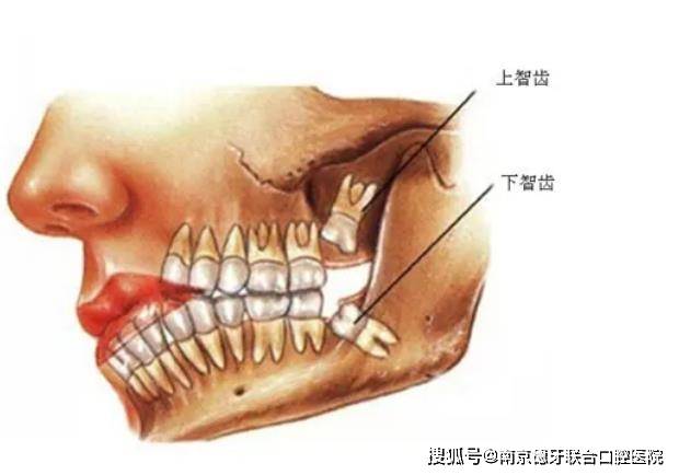 南京德牙联合口腔:智齿被肉包起来怎么办?