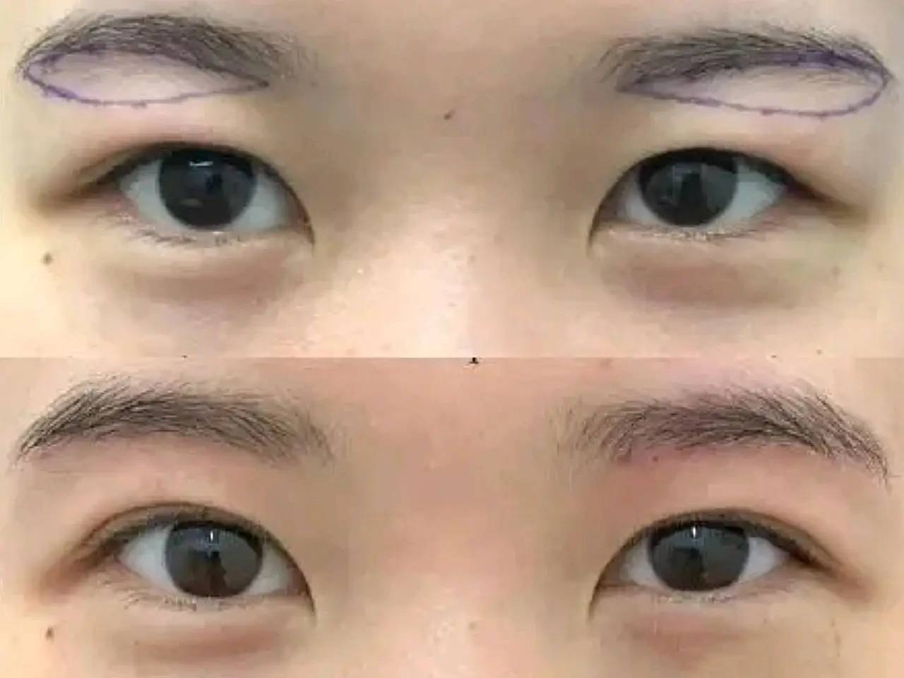 提眉是什么样的整容手术提眉可以改善什么问题