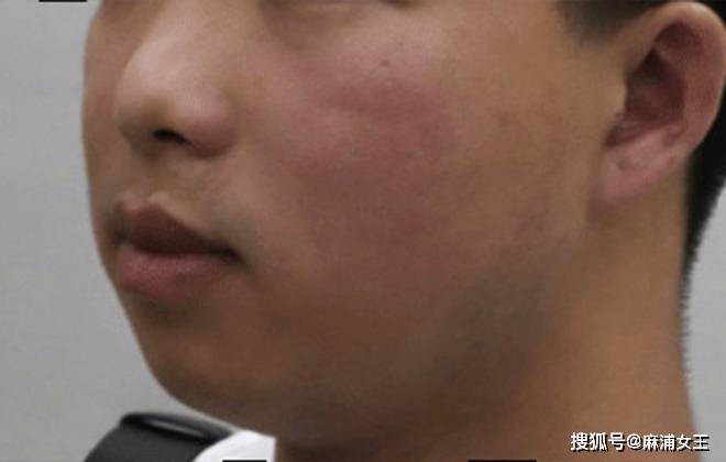 印第安纹用小针刀剥离效果怎么样印第安纹怎么才能完全消退下去