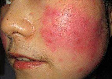 怎么修复红血丝敏感肌肤?_皮肤_屏障_丝都