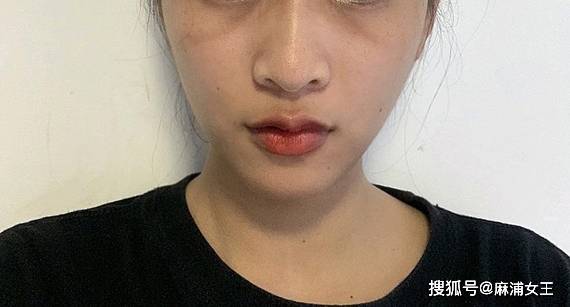 印第安纹剥离会导致增生想剥离消退印第安纹的朋友看过来