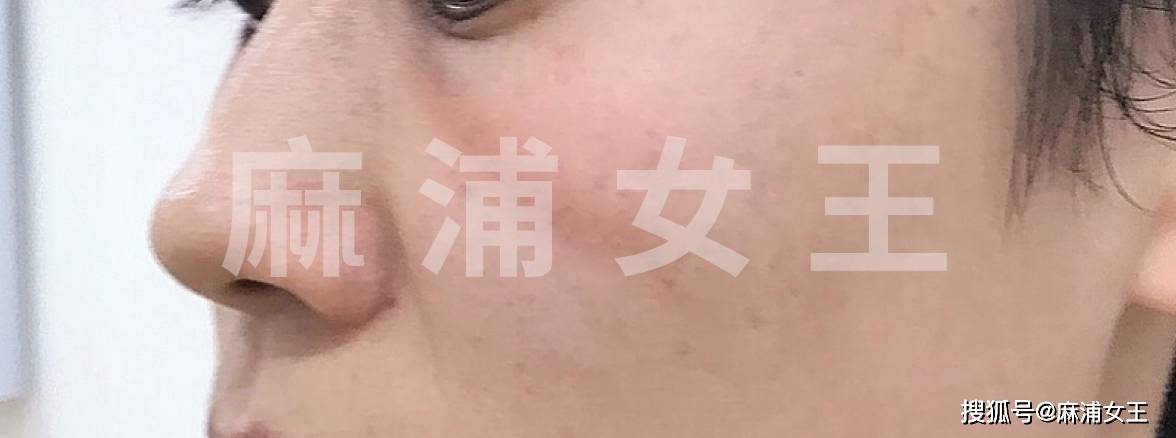 印第安纹到底能不能解决北京印第安纹剥离哪里能做