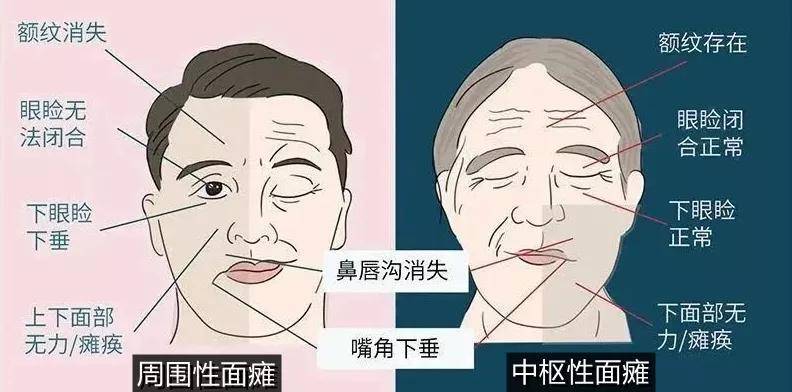 發生面癱的徵兆有哪些