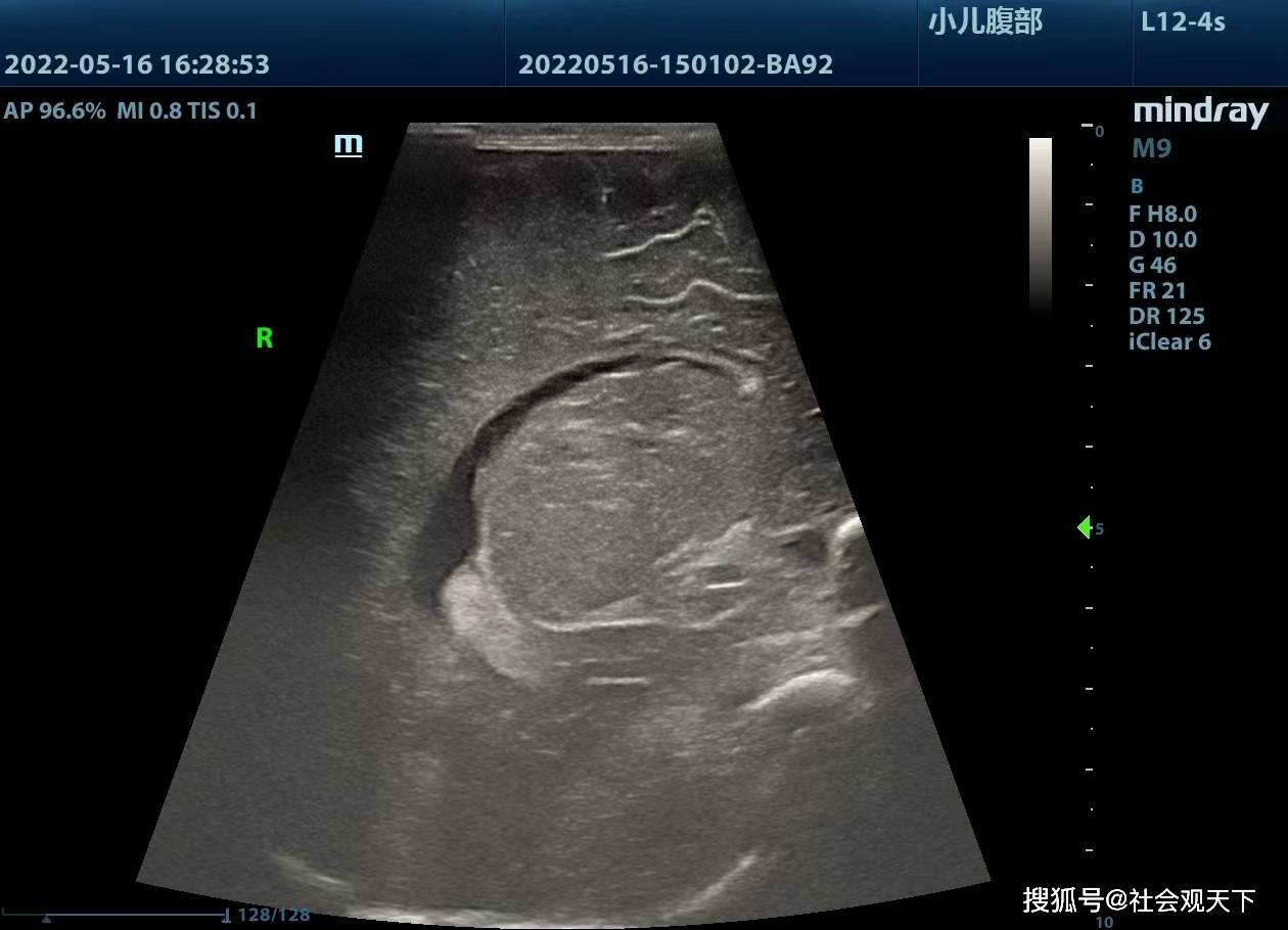 松潘县人民医院开展新生儿颅脑肺部超声检查项目为宝宝健康保驾护航