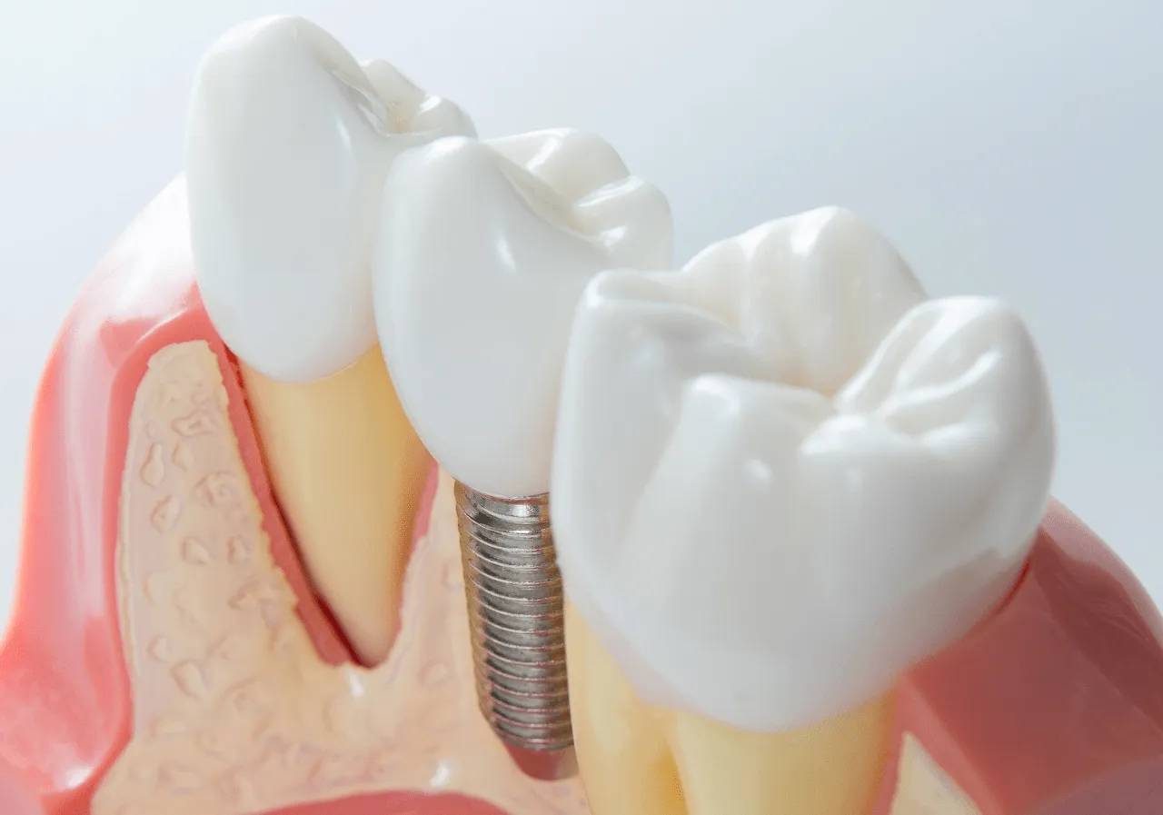 北京全口种植医生刘体亮科普:种植牙过程是什么样?