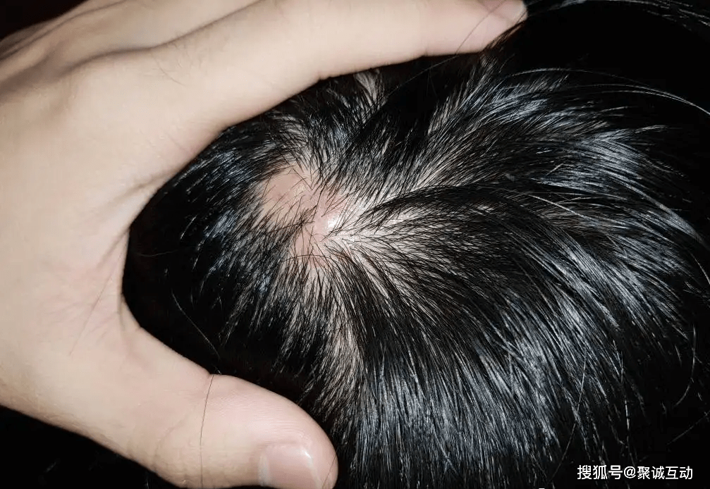 脱发小白必知丨毛囊炎会导致永久性脱发?