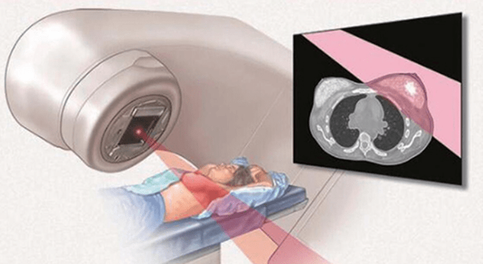 乳腺癌放疗过程图片