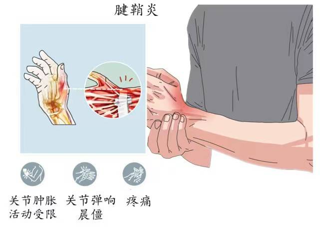 尺侧腕屈肌腱鞘炎图片