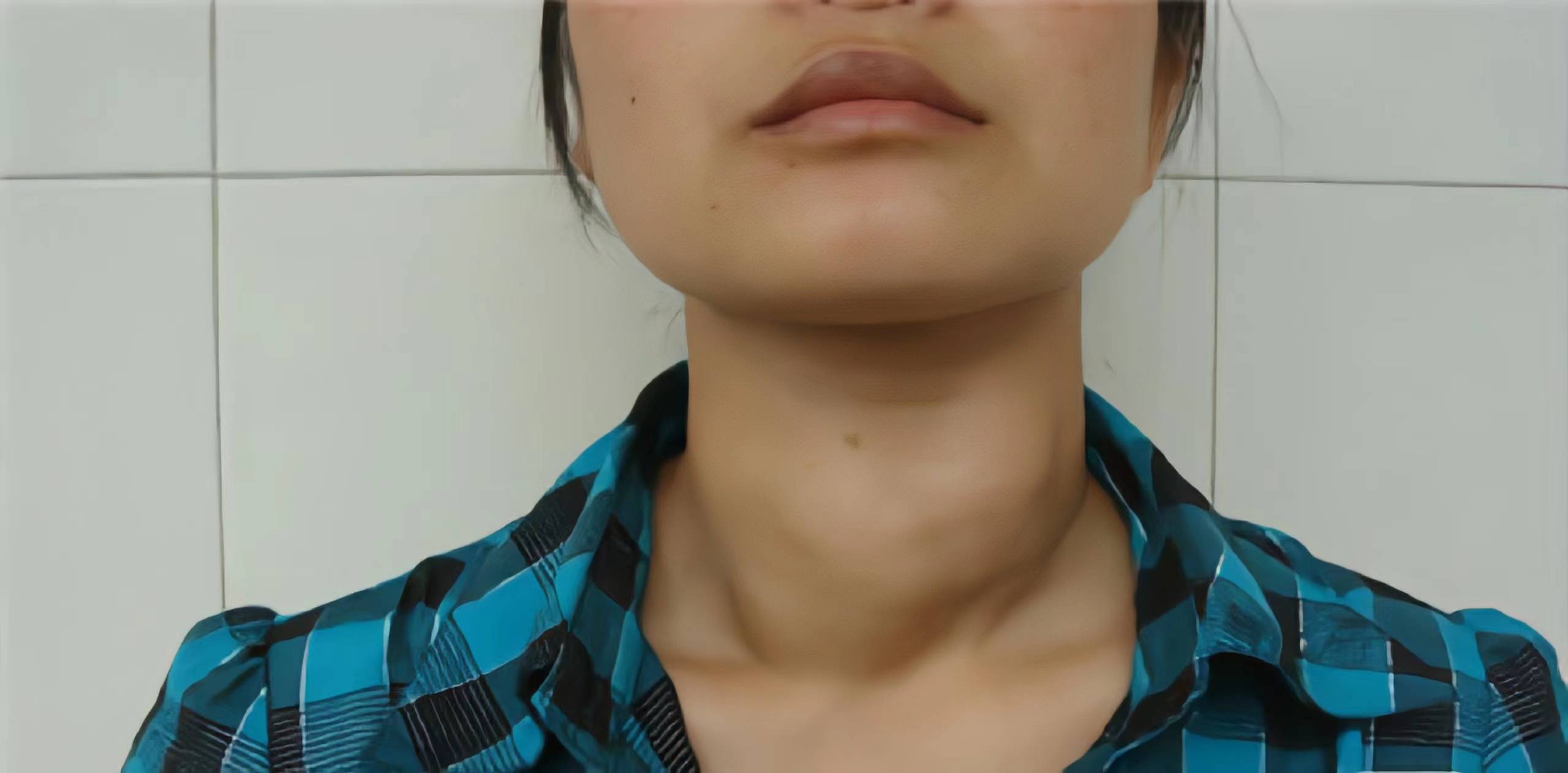 甲亢患者治愈仅仅用时45天,后悔没早点知道!_脖子_时候_个人