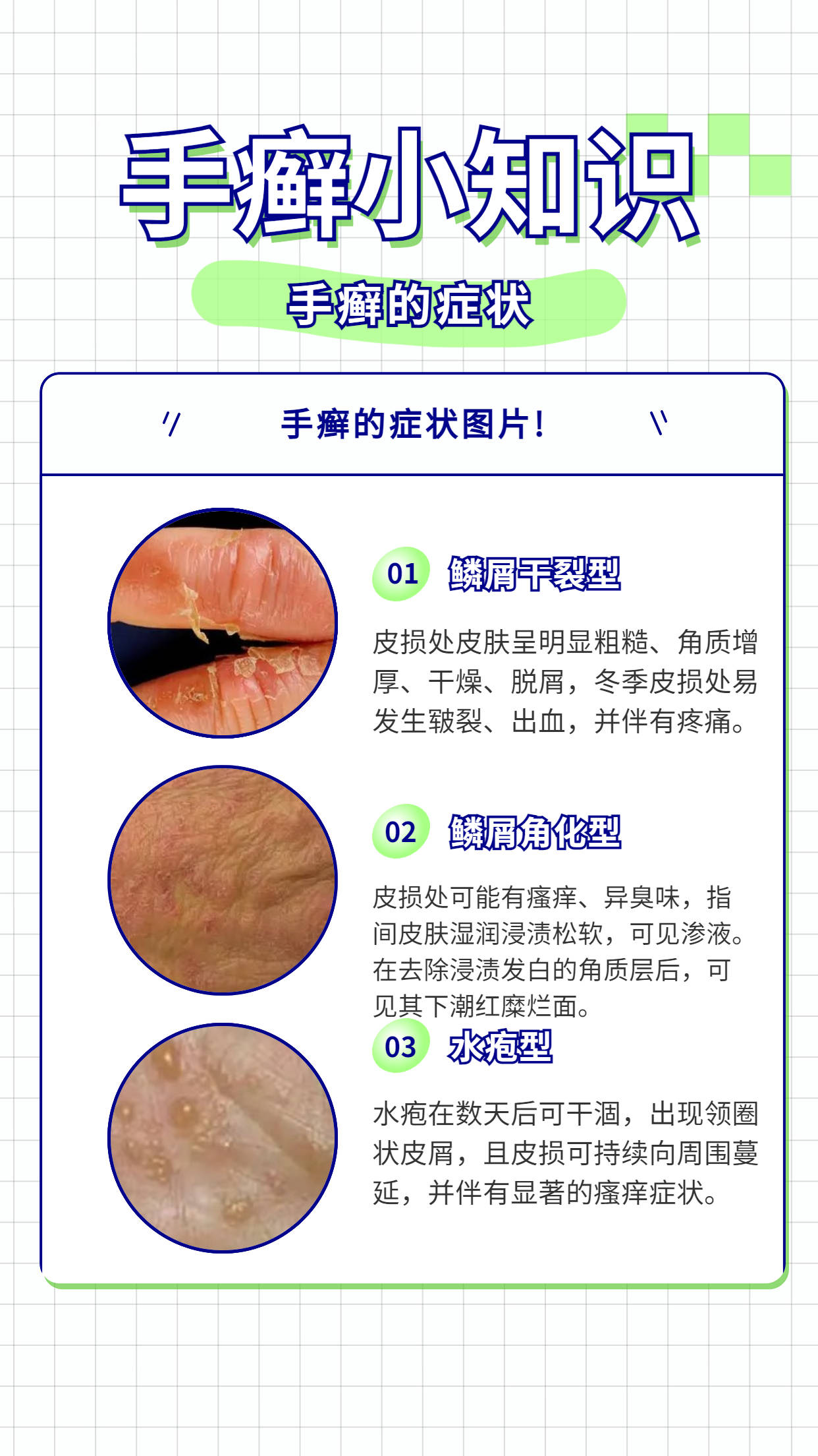 角化型手足癣图片介绍图片