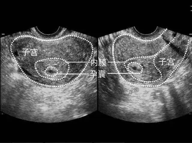 两个孕囊b超图片图片