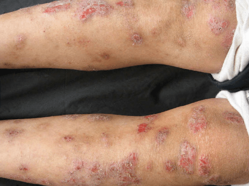 特应性皮炎,主要表现为全身皮肤干燥,脱屑,瘙痒等等.