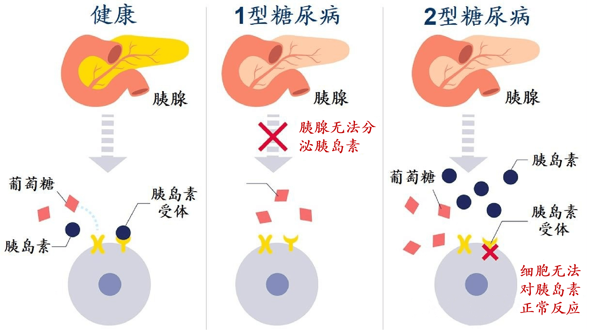 好发于成年人,主要是由于胰岛素抵抗,胰岛素进行性分泌不足导致的