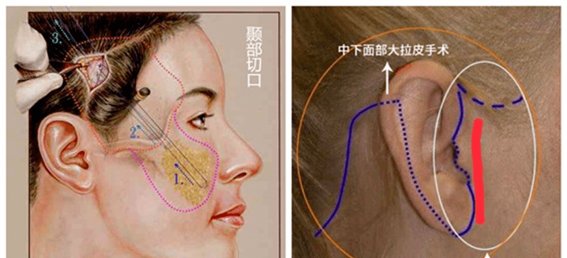 印第安纹去做拉皮好还是剥离好?_面部_影响_皮肤