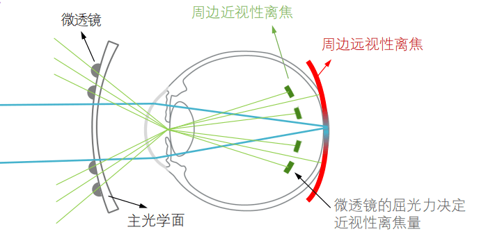 近视眼的成像原理图解图片