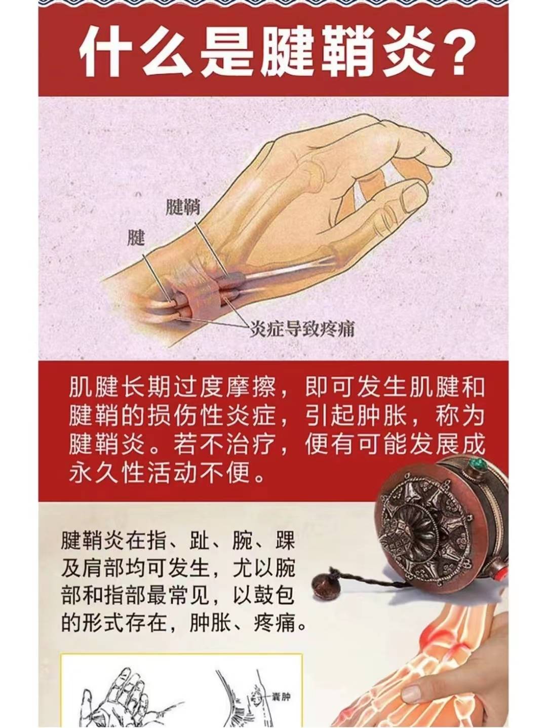 对于腱鞘炎,医生列出4种症状的具体表现,快看自己中招了没?
